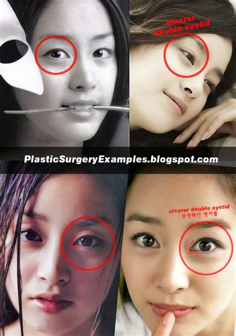 Plastic Surgery Examples Kim Tae Hee Plastic Surgery