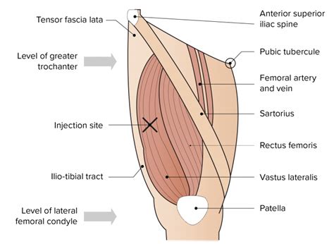 Figure Anatomical Markers Used To Identify The Vastus Lateralis Injection Site On The