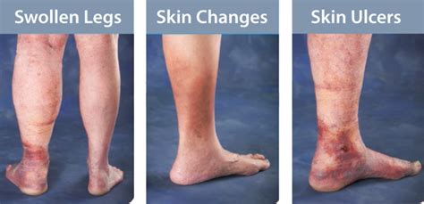 Varicose Vein Treatment Northpointe Medical