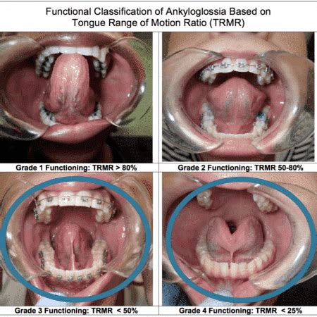 Tongue Tie Release For Those 1 Year And Older Dr Erica Zolnierczyk