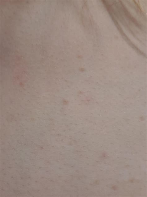 Small Discored Spots Appeared Recently On My Chest And Stomach Should