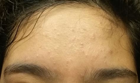 Clogged Pores Acne Acne Scars Help Please General Acne Discussion