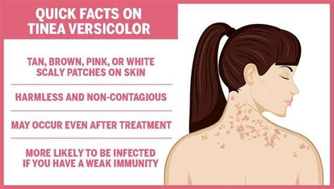 Understanding Tinea Versicolor Causes Symptoms Treatment And Prevention