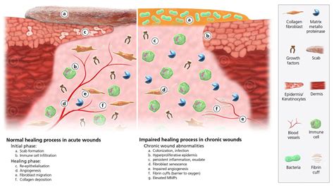 Comparison Chronic And Acute Wound Chronic Wind Healing Process