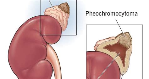 Pheochromocytoma Symptoms Causes Prognosis Healthy Food Near Me