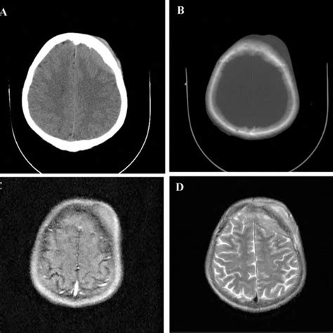 Axial Ct Scan Ab A Calvarial Lesion With Both Extra And