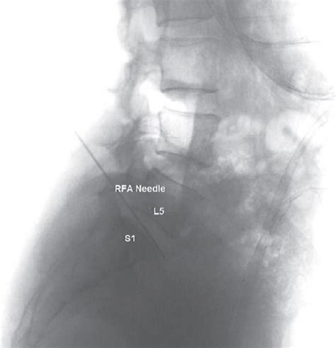 Cureus Radiofrequency Ablation Of The Splanchnic Nerve And Superior