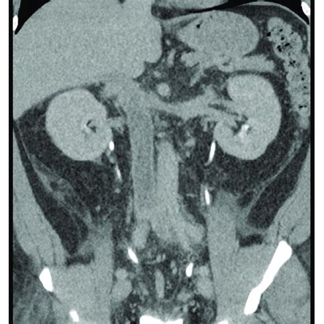 Initial Computed Tomography Ct Urogram Demonstrating Left Renal Vein