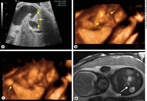 Annular Pancreas Ultrasound