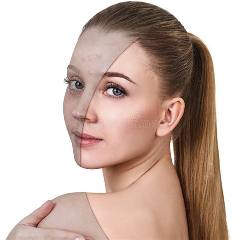Young Woman With Acne Before And After Treatment Stock Image Image