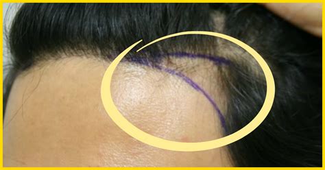 Parts 2 treating your hair loss with medications 3 exploring other treatment options hair loss in women at any age and for any reason is discouraging, frustrating, and sometimes. 8 Simple Ways To Treat Hair Loss At The Temples