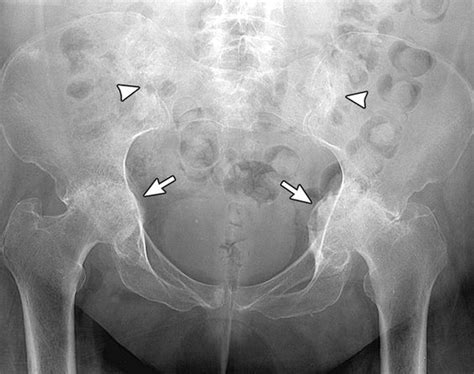 Rheumatoid Arthritis Anteroposterior Pelvis Radiograph Shows Bilateral
