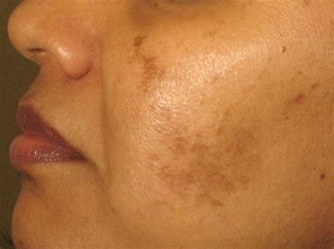 Why The Blemishes On Your Skin Healthgistnet