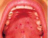 Pictures of Itchy Tongue And Roof Of Mouth