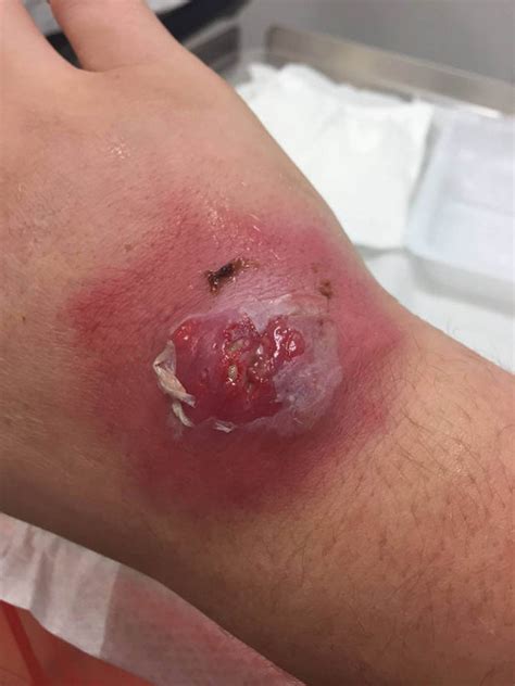 Spider Bite Agony Man Left With Gaping Hole In Hand After False Widow