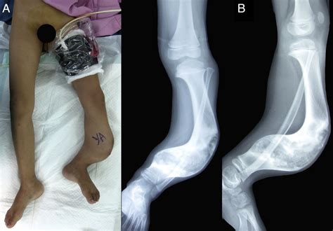 Preoperative Clinical Photograph And Plain Radiography A Significant
