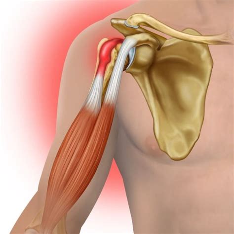 Distal Biceps Tendon Repair Elbow Surgeon South Windsor Rocky Hill