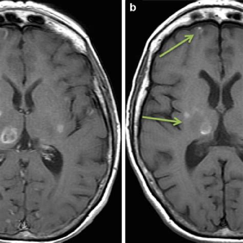 Cerebral Toxoplasmosis Panel A Post Contrast Axial Ct Showing A