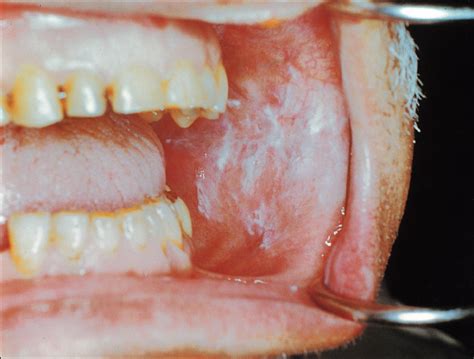 white oral lesions how to distinguish the benign from the deadly consultant360