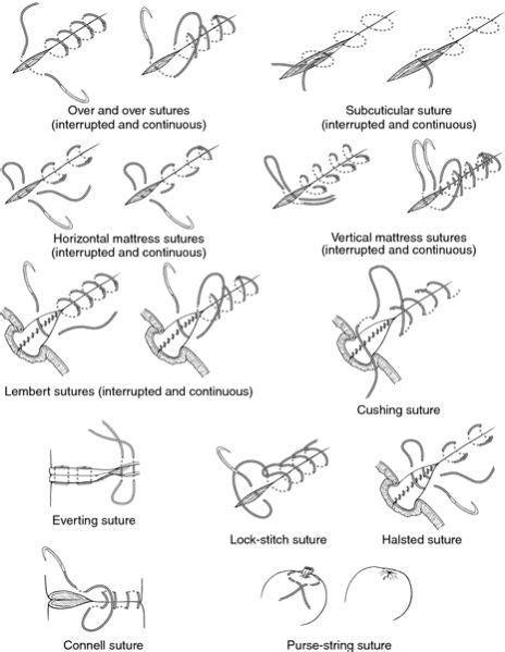 Suturing Techniques Stitches Medical Surgical Suture Medical Knowledge