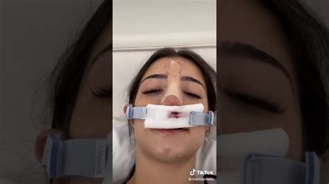 Charli Damleio Nose Surgery Youtube