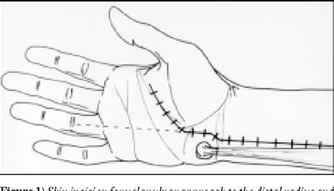 Figure 1 From Volar Ulnar Approach To The Distal Radius And Carpus