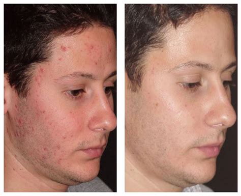 Acne And Scar 55th Laser Clinic