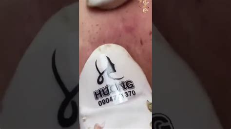 Pimple Popping 2021 Blackheads And Whiteheads 12 Youtube