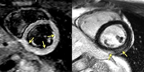 J magn reson imaging 2007; Cardiac Magnetic Resonance Assessment of Myocarditis ...