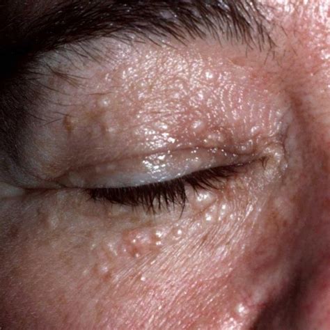 Bumps Under Eyes What Are They And How To Get Rid Of