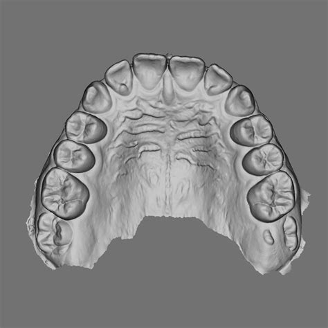 Free Stl File Superior Maxillary From Intraoral Scan Area3d Patient