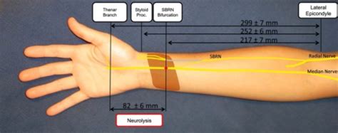 Transfer Of The Superficial Branch Of The Radial Nerve Open I