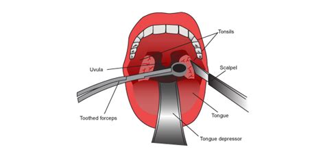 10 Best Tonsillectomy Recovery Images Tonsillectomy R