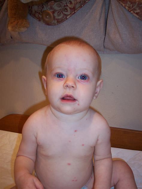 Chickenpox Infants Pictures Photos