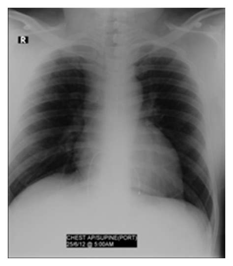 Cxr Shows Cardiac Enlargement And Pulmonary Venous Congestion