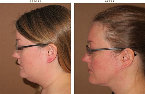 Liposuction Of The Neck Before And After Pictures Dr Turowski