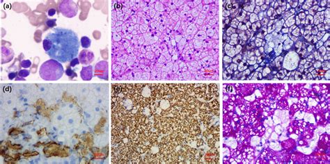 A Smears Of Bone Marrow Aspiration Revealed Sea Blue Histiocytes