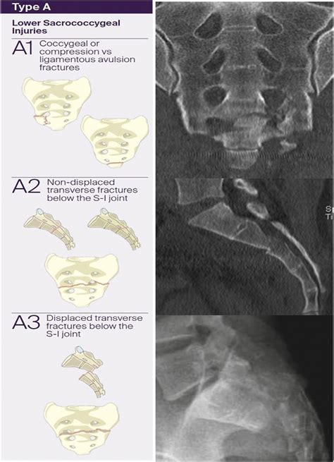 Classifications In Brief The AOSpine Sacral Classification