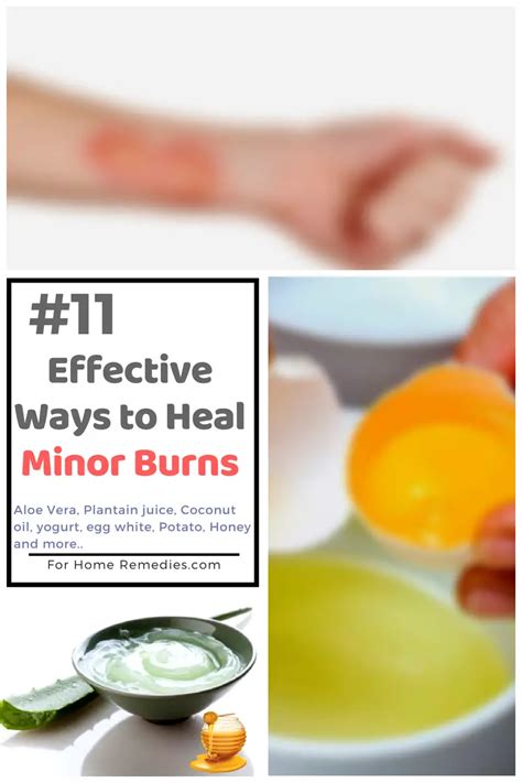 11 Quick Soothing Home Remedies For Minor Burns Effective Ways