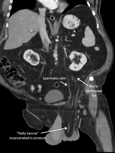 Full Text Computerized Radiography Of Incarcerated Fatty Hernia