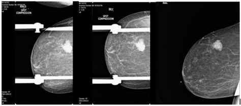 Diagnostic Mammogram Spot Compression Mediolateral Oblique Spot