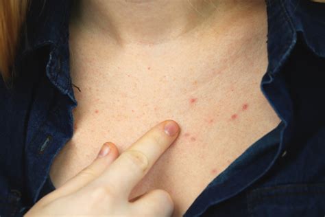 Chest Acne What Causes It And How To Get Rid Of It