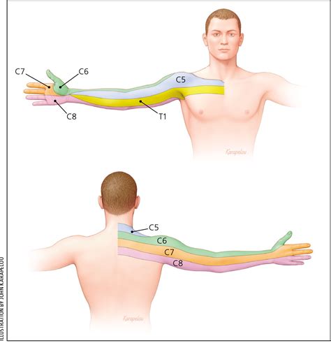 Observed Patterns Of Cervical Radiculopathy How Often Do 56 Off