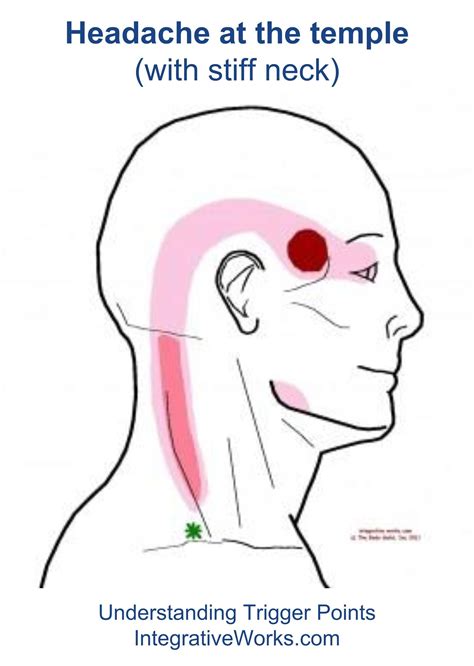 Understanding Trigger Points Headache At Your Temple Jaw Pain