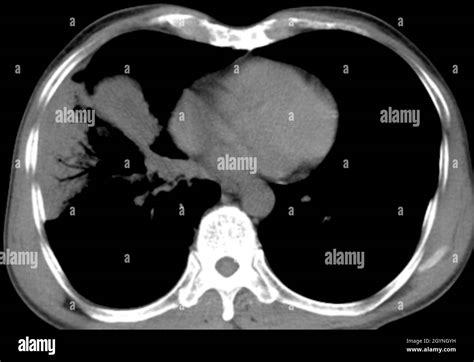 Lung Cancer Ct Scan Stock Photo Alamy