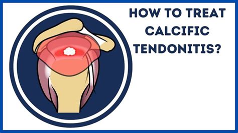 How To Treat Calcific Tendonitis YouTube