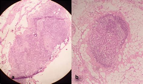 A False Negative Intraoperative Frozen Sentinel Lymph Node Biopsy Due