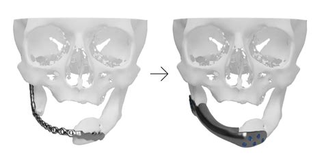 Mandibular Reconstruction Using A 3d Printed Titanium Implant With