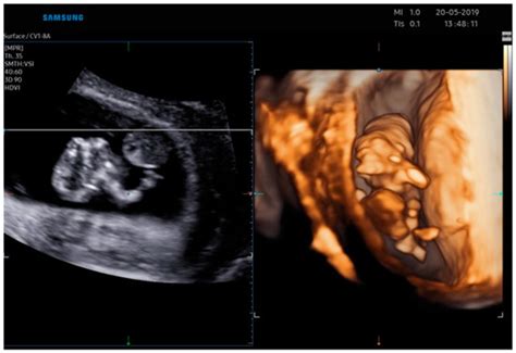 Jcm Free Full Text Body Stalk Anomaly Complicated By Ectopia Cordis