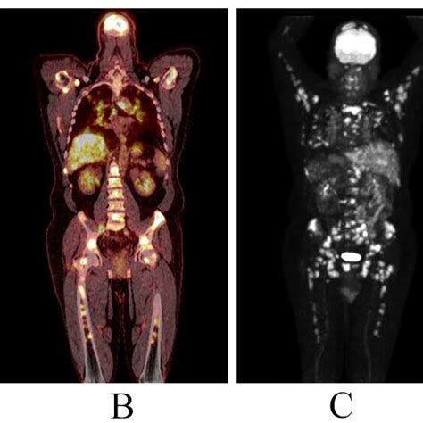 A Axial Fusion Image Of Fdg Petct Scan Showing Hypermetabolic